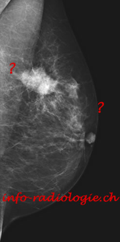 Echographie et cancer du sein