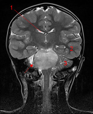 Gliome du tronc cérébral.