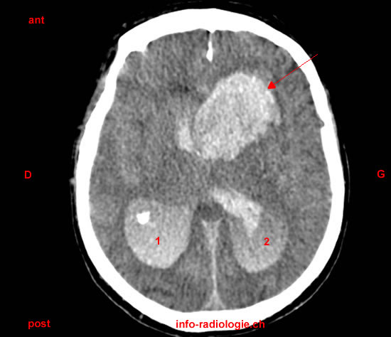 Hématome intra-cérébral (scanner)