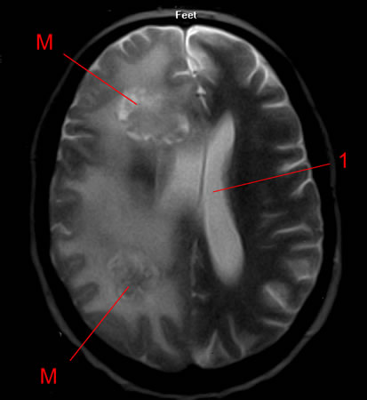 IRM - métastases cérébrales d'un cancer du poumon