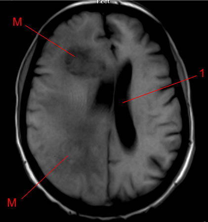 IRM - métastases cérébrales d'un cancer du poumon