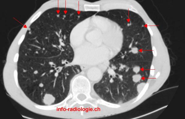 Métastases pulmonaires (scanner)