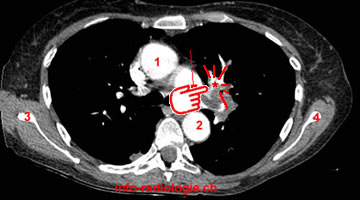 Embolie pulmonaire cancer pancreas