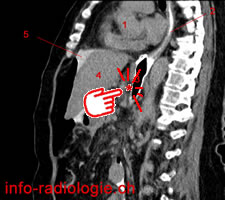 Perforation de l'estomac par un stent oesophagien. Image 0
