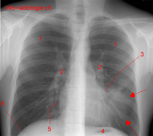 Pneumopathie de la lingula (radiographie)