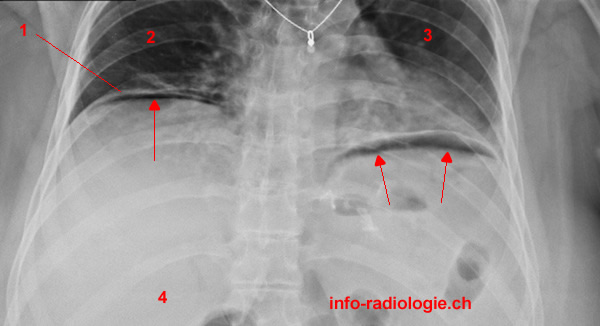 radio du thorax montrant un pneumothorax