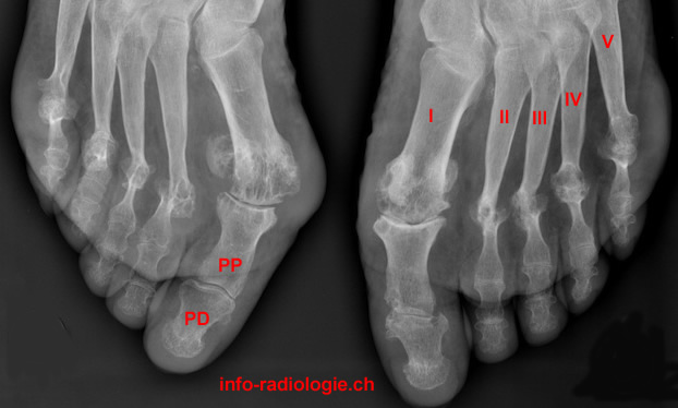 Polyarthrite rhumatoïde: atteinte du pied: Image 1