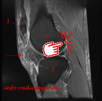 Rupture tendon patella. Image 1