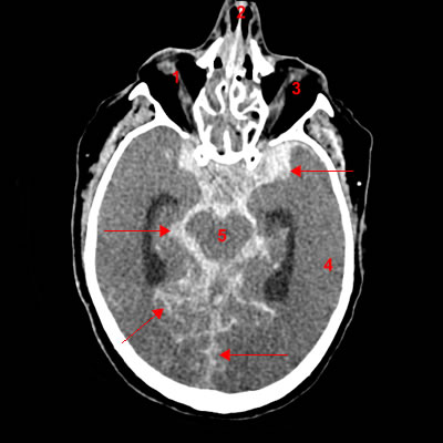 Tomodensitométrie du cerveau (scanner cérébral)